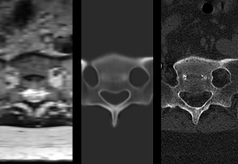 Synthetic CT and Radiation-Free Orthopedics: The Economics of Single-Modality MRI Surgical Workflows